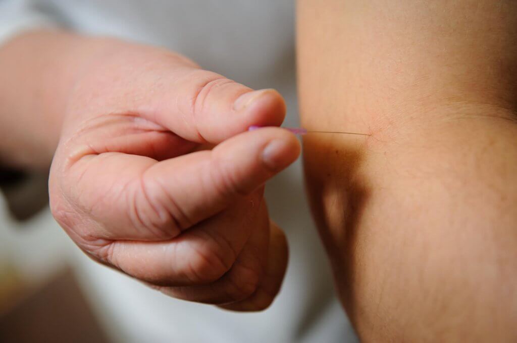 Acupuncture needles being inserted into a patient's skin