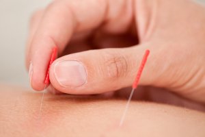 Acupuncture can help with a range of ailments