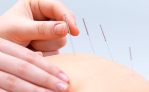 weight loss with acupuncture
